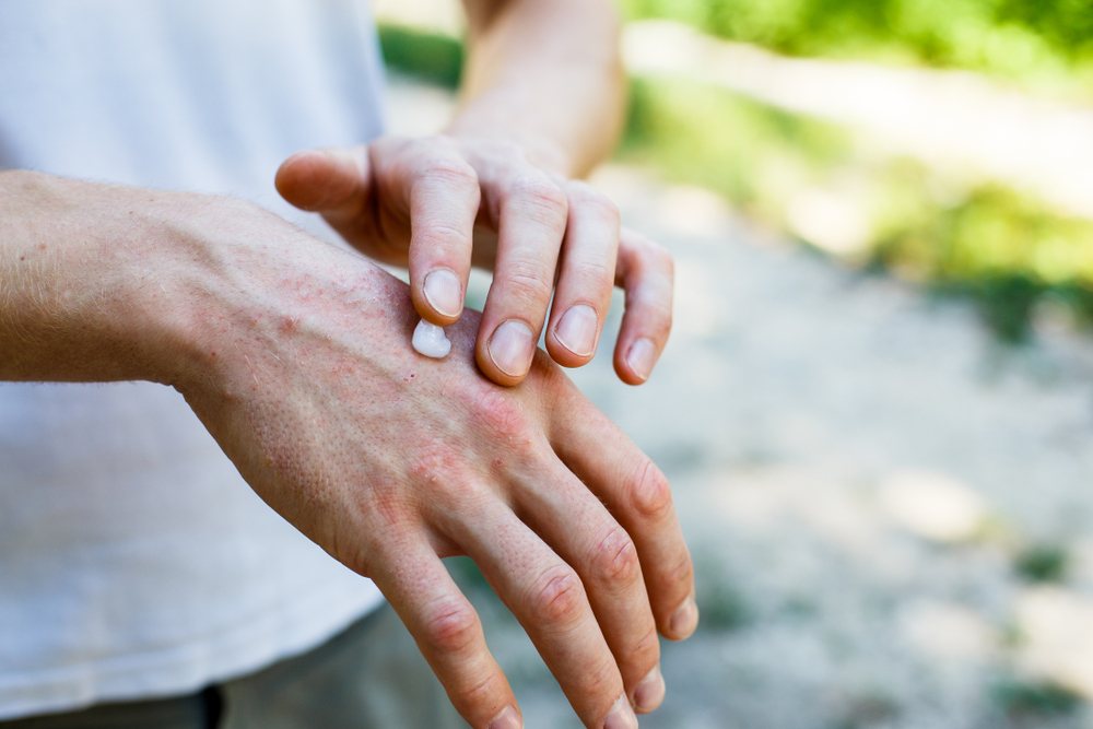 Man with rash on hand