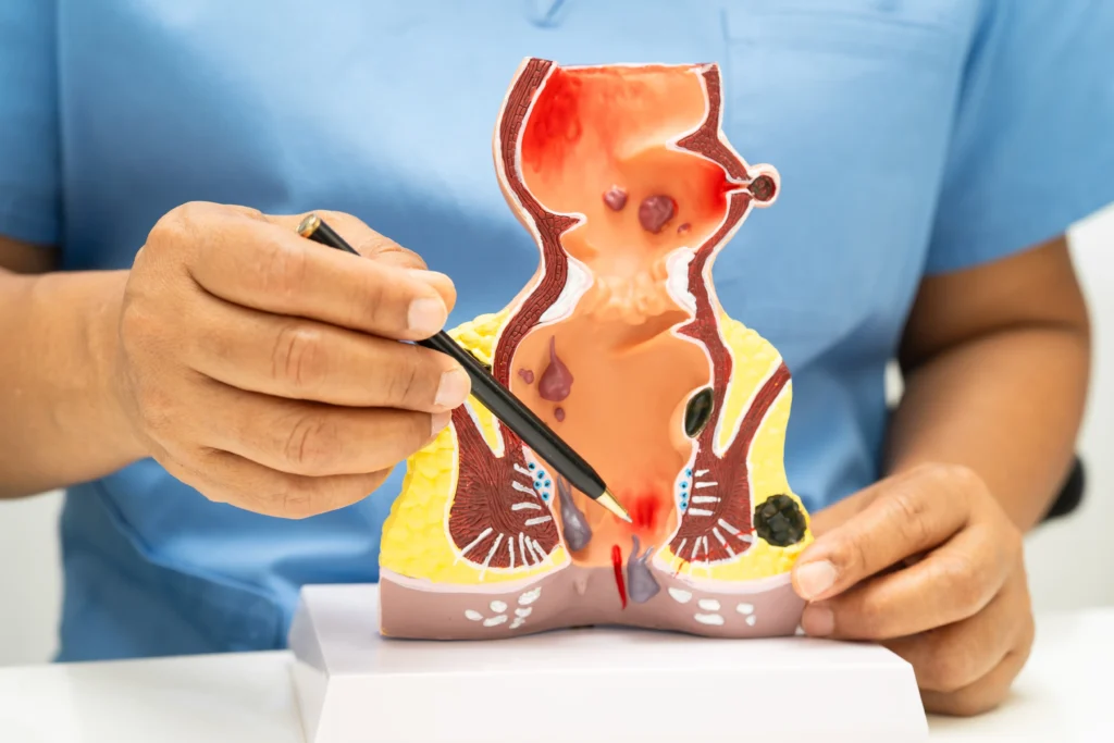 A medical professional points with a pen at a cross-section anatomical model of the rectum and anus, highlighting inflamed tissue and hemorrhoids.