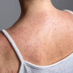 Q&A: What to know about measles