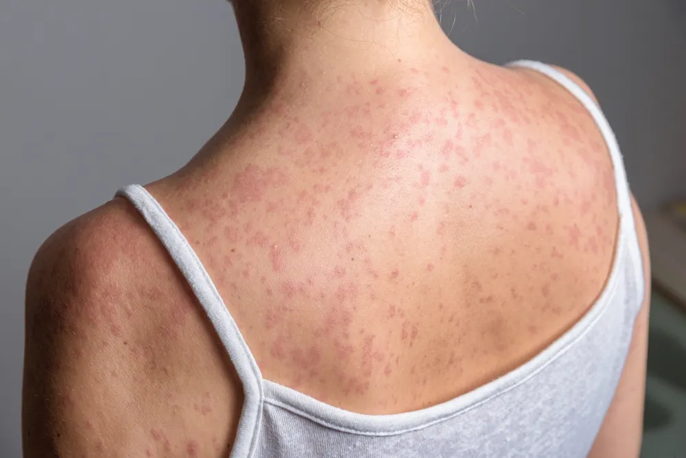 A person wearing a white tank top can be seen with a measles rash across their back.